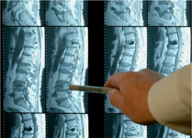 Variedades de osteocondrose na coluna