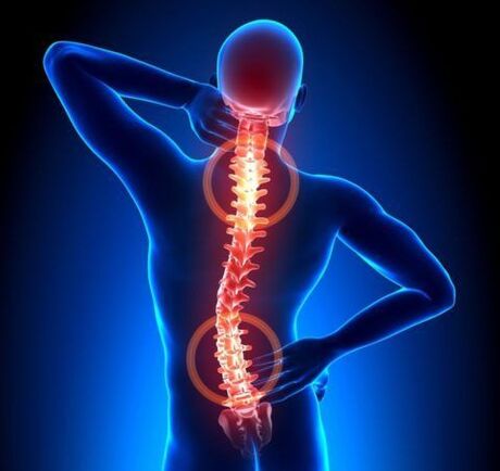 Osteocondrose da coluna