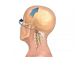 Como osteocondrose da coluna cervical se manifesta