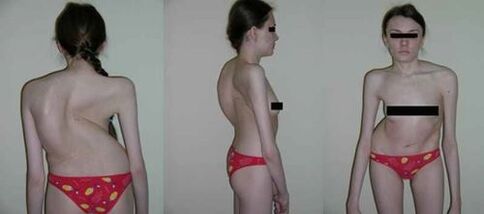 curvatura da coluna vertebral como conseqüência da osteocondrose