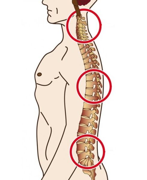 departamentos espinhais em que a osteocondrose ocorre