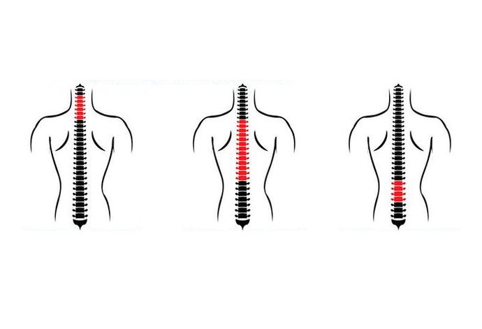 Como a osteocondrose se manifesta