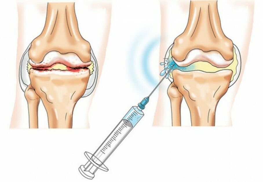 injeção na articulação do joelho com artrose