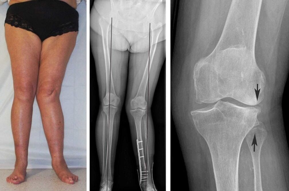 A artrose avançada das articulações do joelho é claramente visível visualmente, mesmo sem raios-x