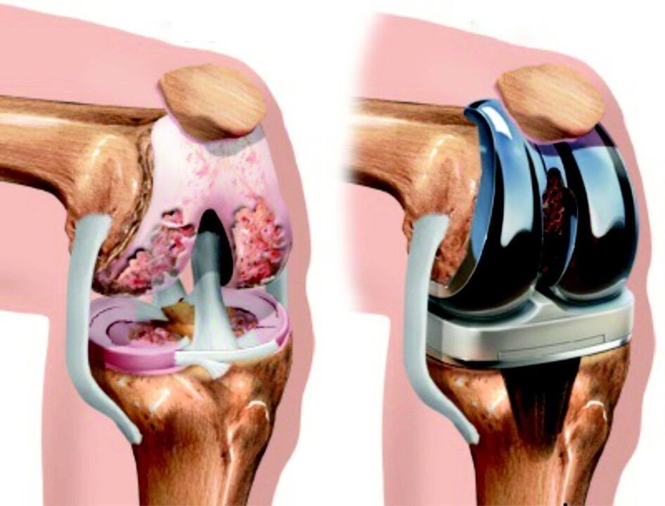 Em caso de dano total à articulação do joelho por artrose, ela pode ser restaurada por endoprótese
