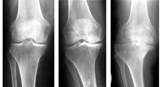 Uma medida diagnóstica obrigatória na identificação de artrose do joelho é a radiografia